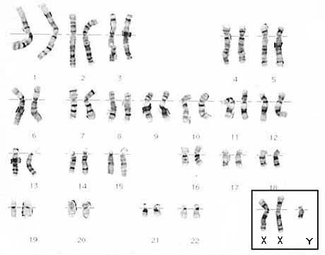 47,XXY Karyotype