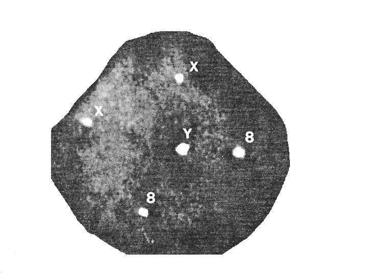 47,xxy germ cell